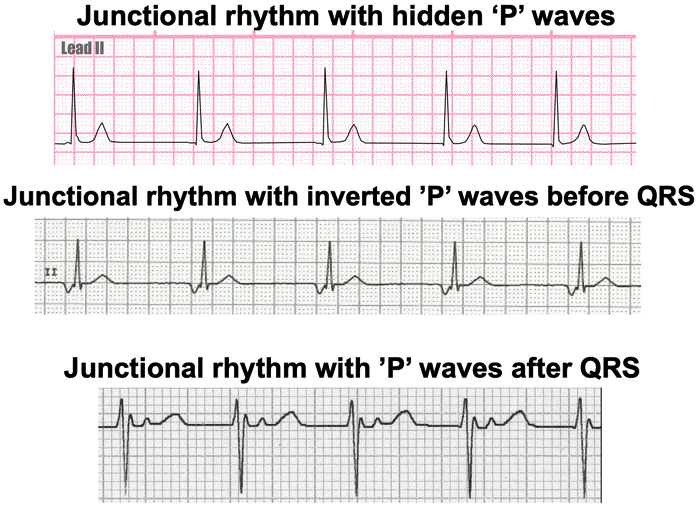 Premature Junctional Complex