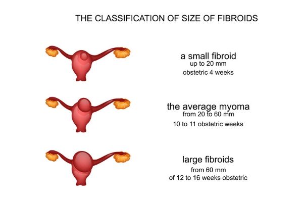 How Fibroids Are Measured