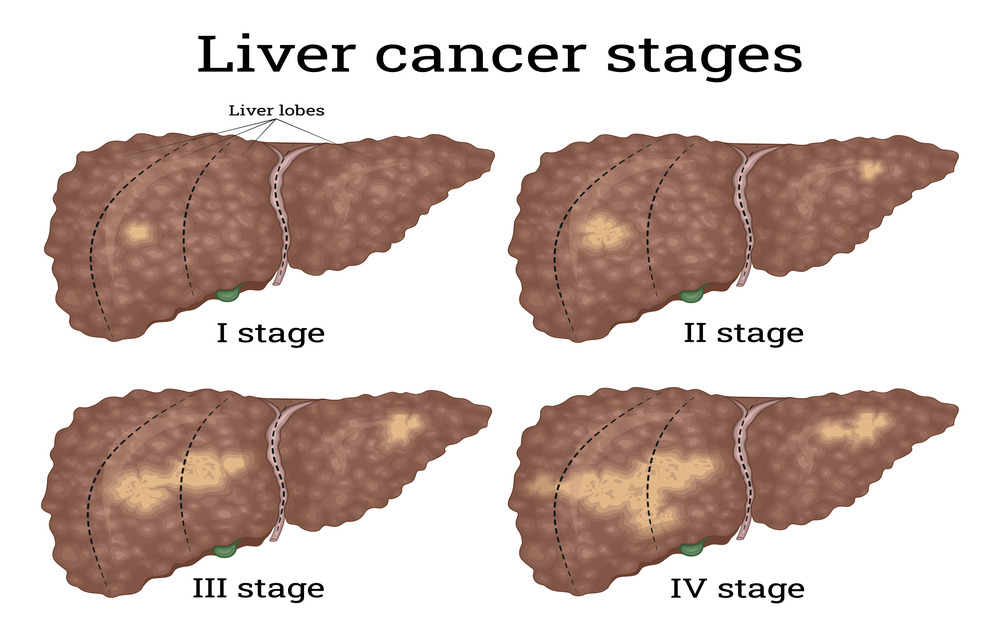 What Is Liver Cancer