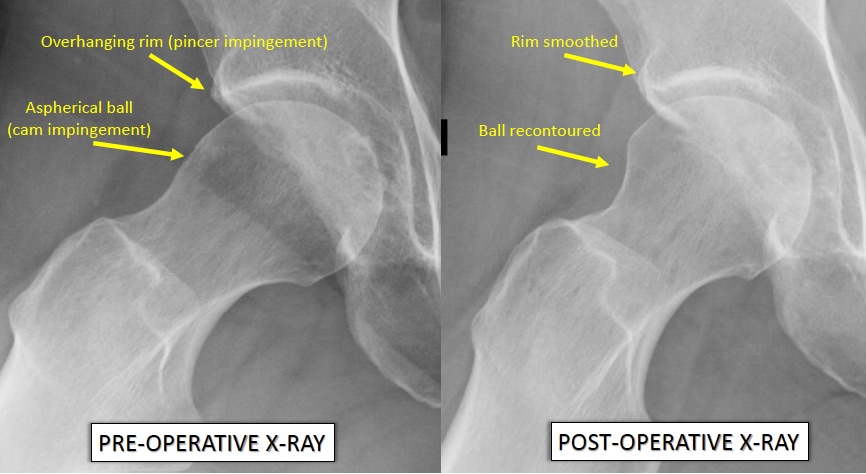 Case Study: Arthroscopic Hip Surgery for Femoroacetabular Impingement ...