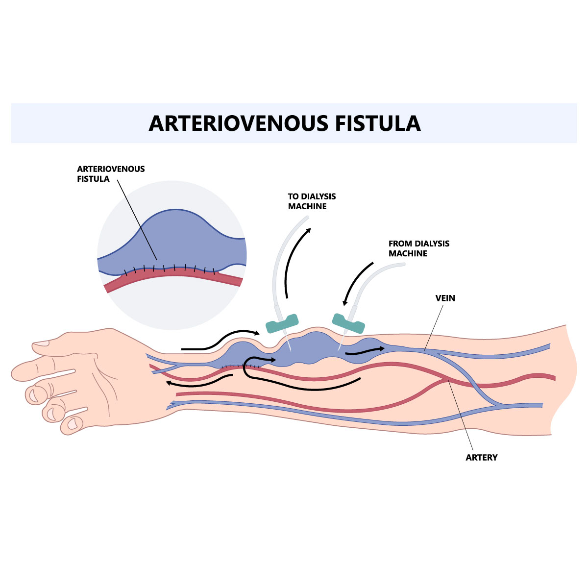 Av Fistula Operation