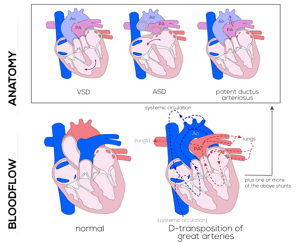 Transposition Of The Great Arteries Coronary Artery Anatomy