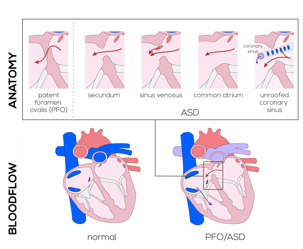 Atrial Septal Defect Types