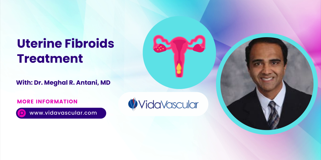 The Minimally Invasive Procedure to Treat Uterine Fibroids | VidaVascular