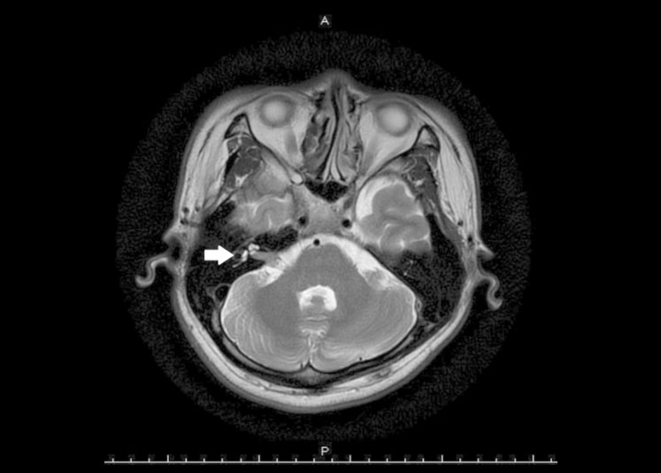 Facial Nerve Schwannomas