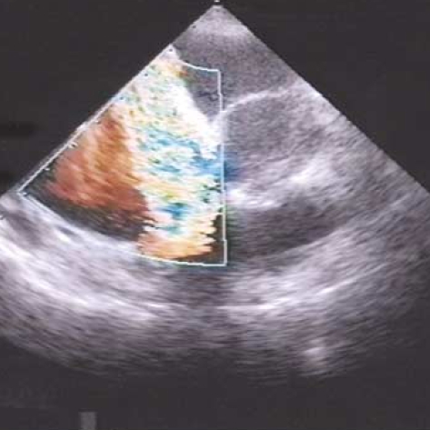 Color-flow Doppler showing severe tricuspid regurgitation.