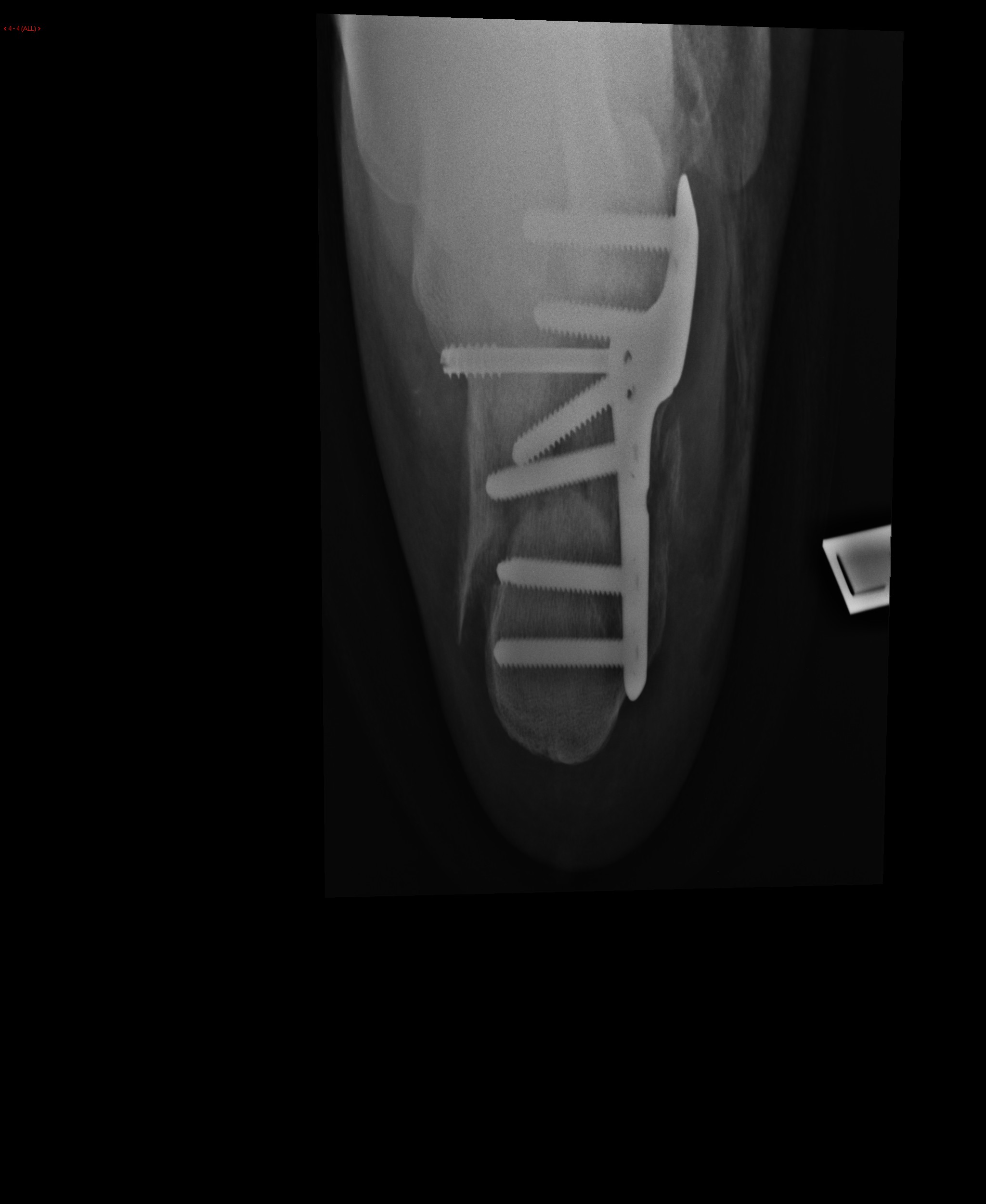 Post operation Calcaneal fracture