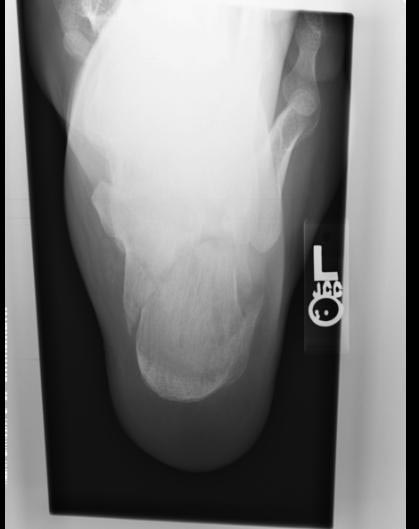 Calcaneal fracture with decreased Bohler's angle.