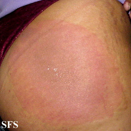 Erythema chronicum migrans - Source: Dermatology Atlas.