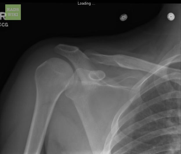 X Ray Shoulder Dislocation