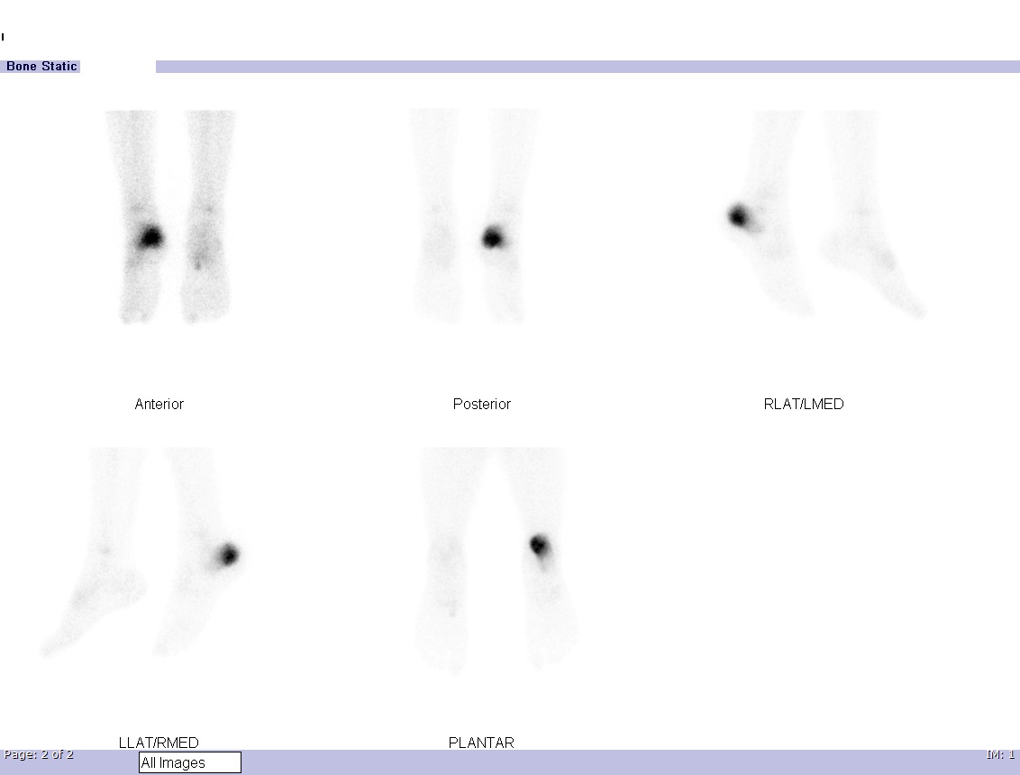 Dynamic flow and blood pool images show increased perfusion and vascularity at the right heel. Delayed static images show an intense increase in tracer uptake localized to the posterior aspect of the right calcaneum highly suspicious of a fracture.