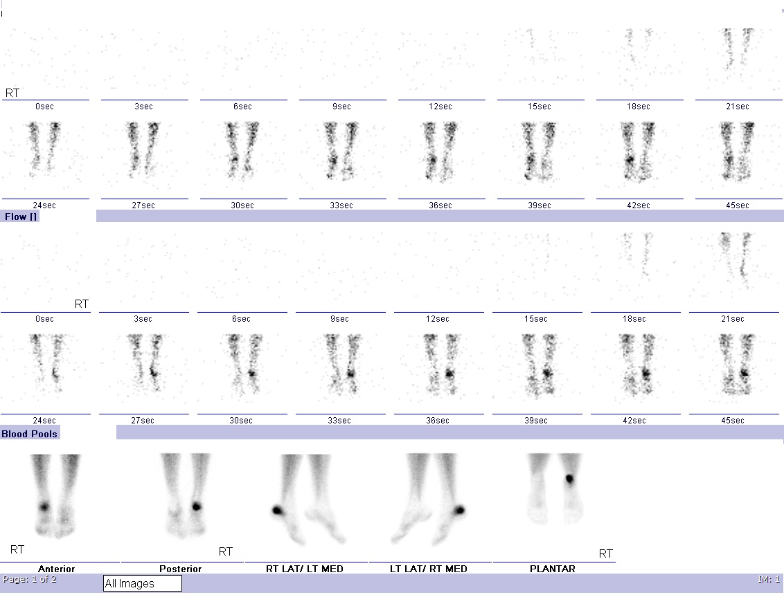 Dynamic flow and blood pool images show increased perfusion and vascularity at the right heel. Delayed static images show an intense increase in tracer uptake localized to the posterior aspect of the right calcaneum highly suspicious of a fracture.