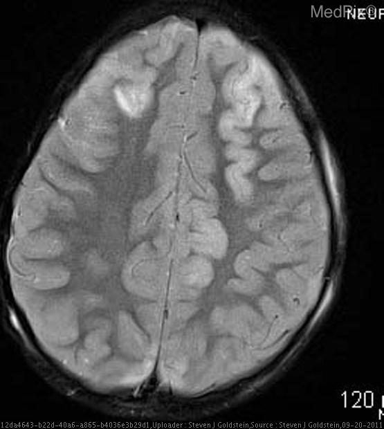 Traumatic Brain Injury Mri