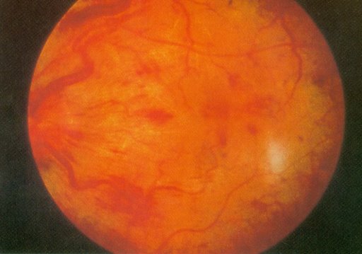 Central retinal artery - wikidoc