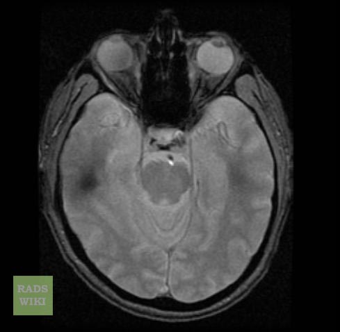 Limbic encephalitis - wikidoc