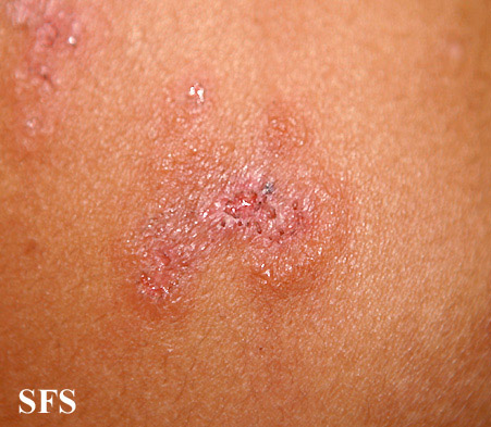 Dermatitis herpetiformis physical examination - wikidoc