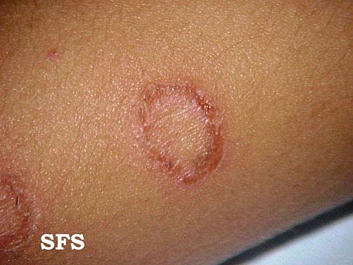 Impetigo physical examination - wikidoc