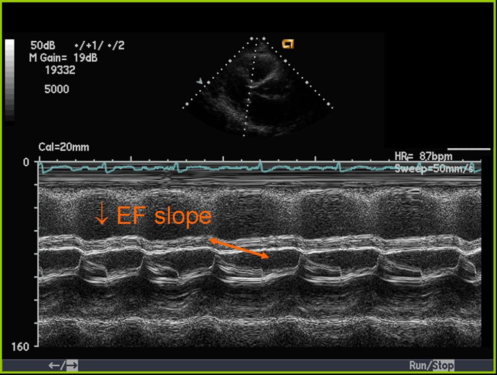 M Mode Echo Of Mitral Valve In A Patient With Mitral Stenosis And | My ... image.