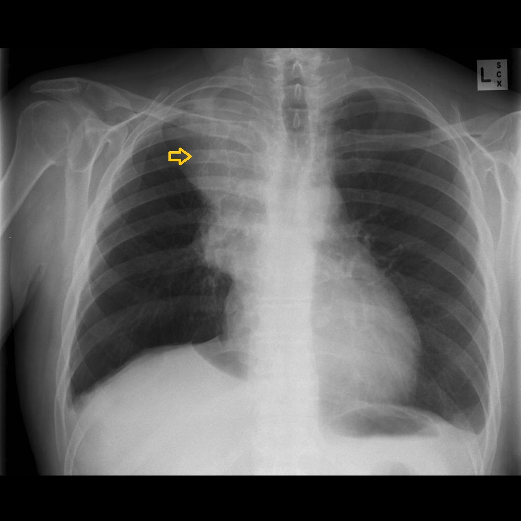 Small Cell Lung Cancer Chest X Ray