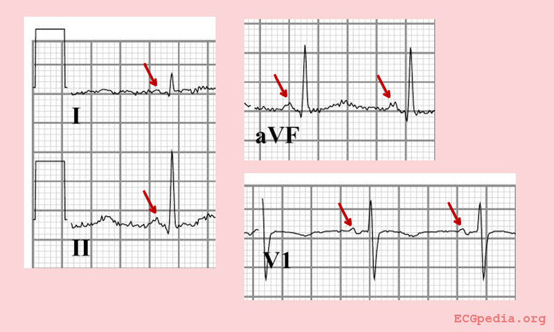 Section Of A Normal Ecg, Lead Ii