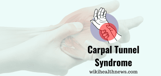 Carpal Tunnel Syndrome