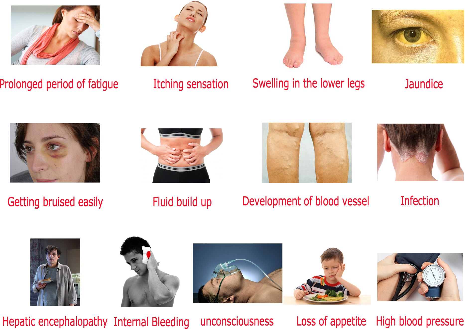 Liver Failure Stages And Signs