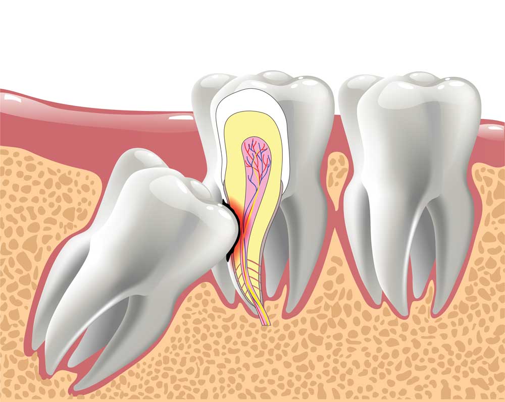 Root Canal Treatment | Dentist in Yankton, SD