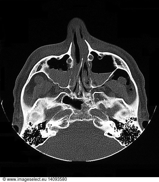 Maxillary Sinus Fractures Maxillary Sinus Fractures, CT,bleeding,blood ...