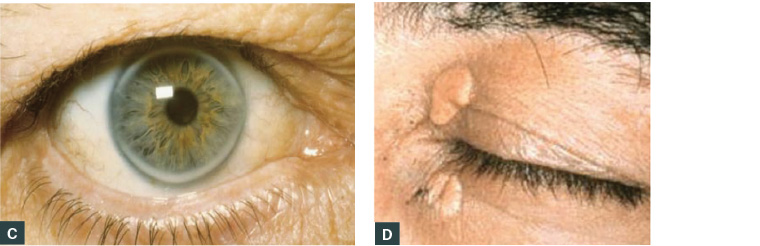 AJGP-08-2019-Viewpoint-Brett-Familial-Hypercholesterolaemia-Fig-1CD.jpg