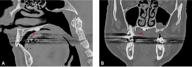 Figure 2. High-resolution computed tomography scan obtained through facial bones and paranasal sinuses