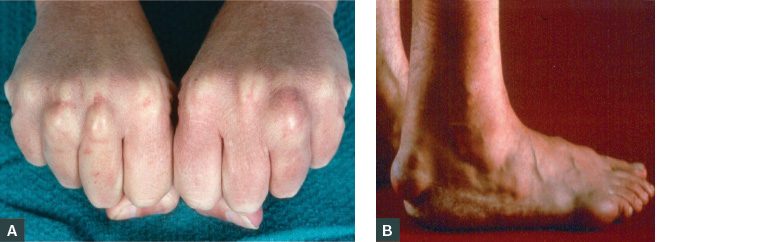 AJGP-08-2019-Viewpoint-Brett-Familial-Hypercholesterolaemia-Fig-1AB.jpg