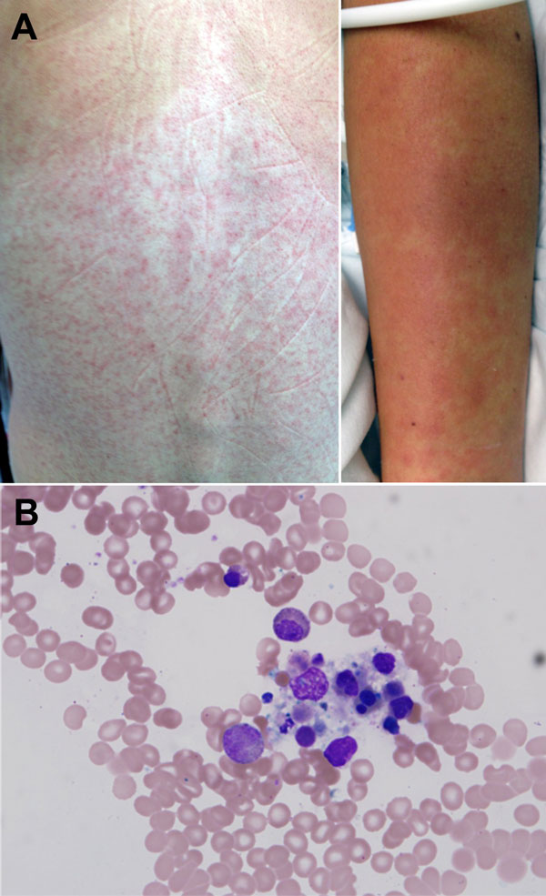 Figure 1 - Novel Paramyxovirus Associated with Severe Acute Febrile ...