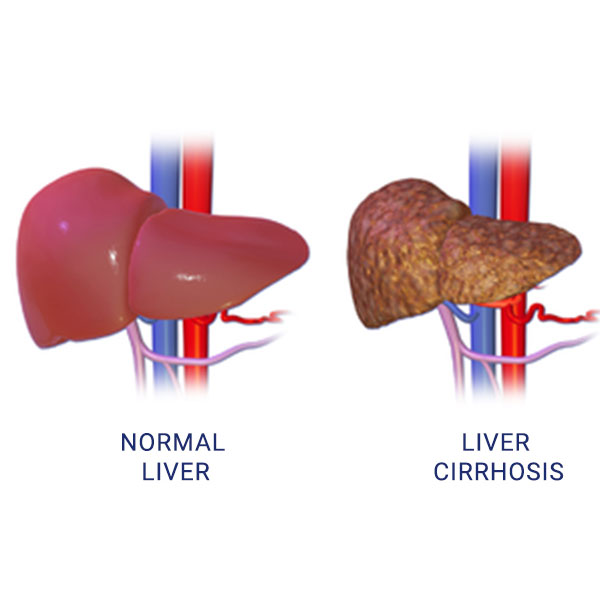 Liver Clinic - Zymus Hospital