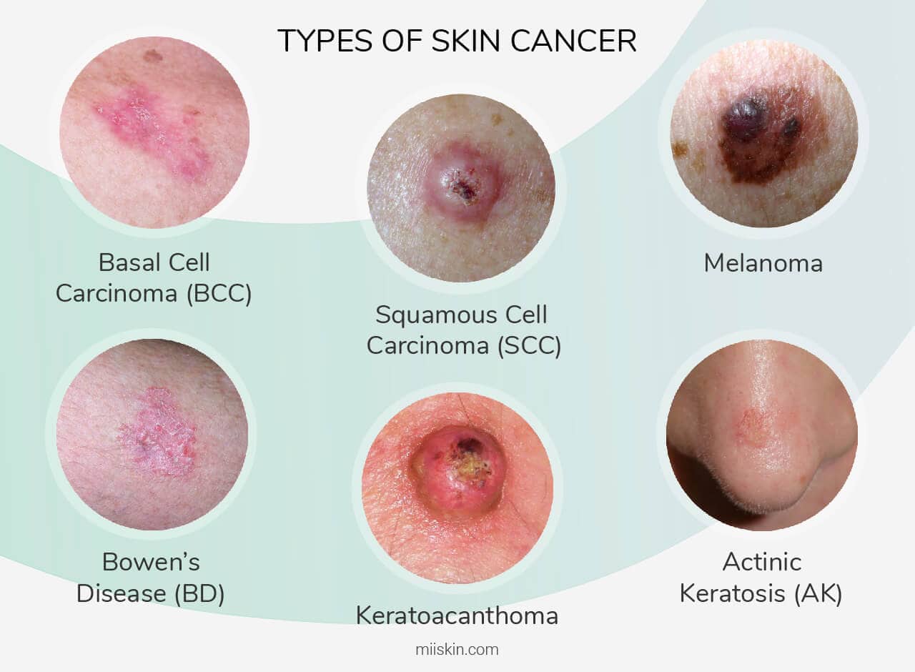 SKIN CANCER